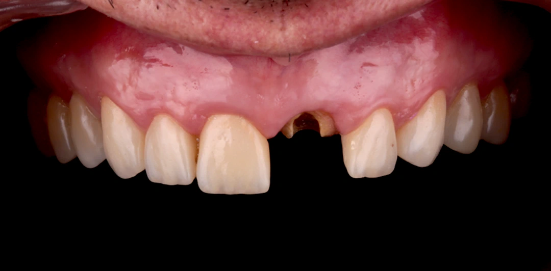 clinica-dental-gilbel-arques-caso-implente-dental-asm-2