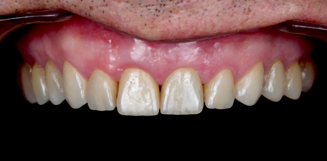 clinica-dental-gilbel-arques-caso-implente-dental-asm-4