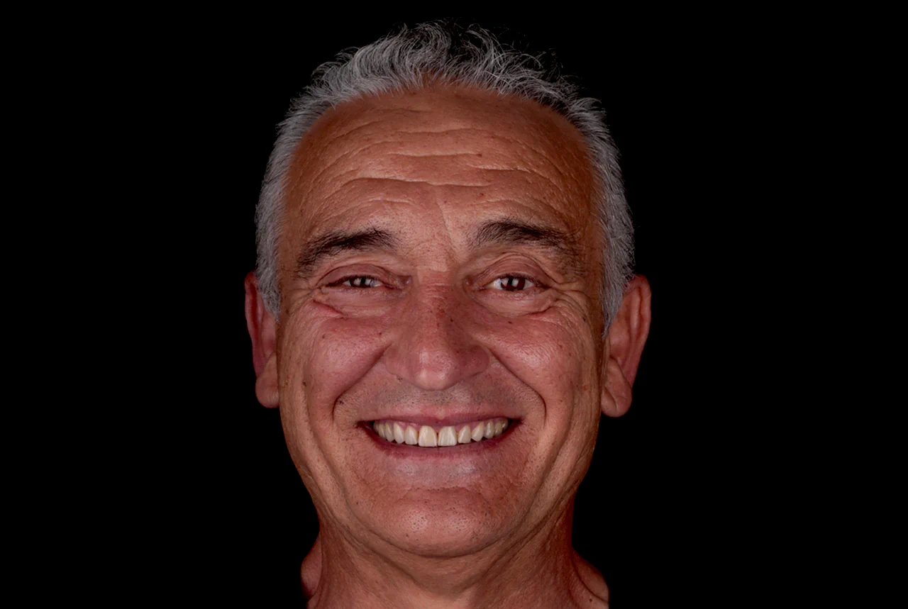 clinica-dental-gilbel-arques-caso-implante-dental-asm-despues