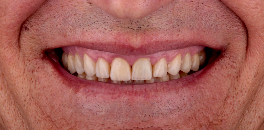 HD clinica-dental-gilbel-arques-caso-implente-dental-asm-5a