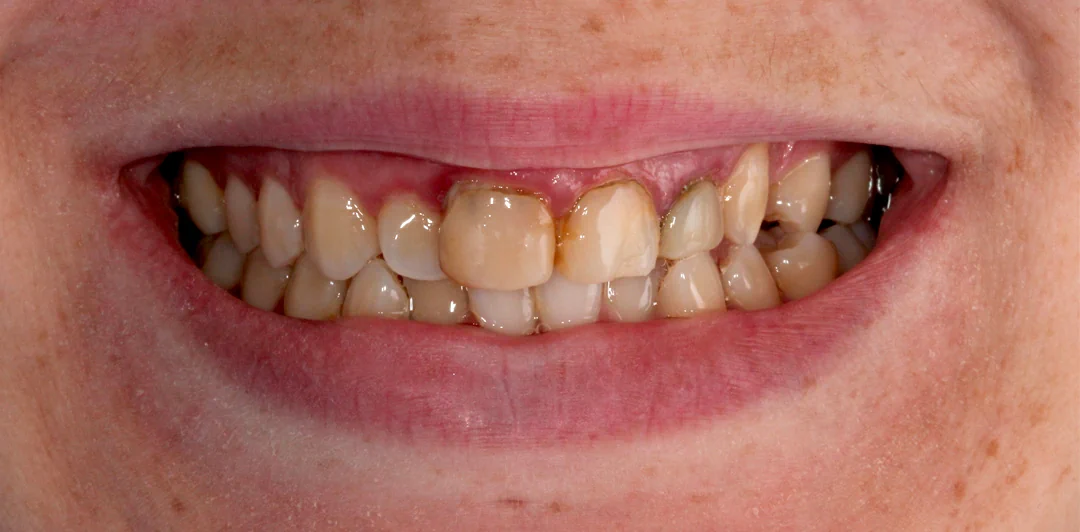 clinica-dental-gilbel-arques-caso-carillas-jag-2