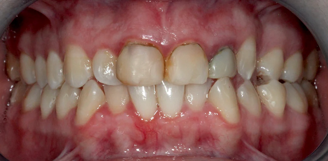 clinica-dental-gilbel-arques-caso-carillas-jag-3