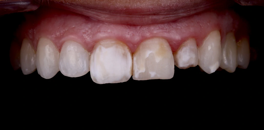 clinica-dental-gilbel-arques-caso-carillas-jag-4a