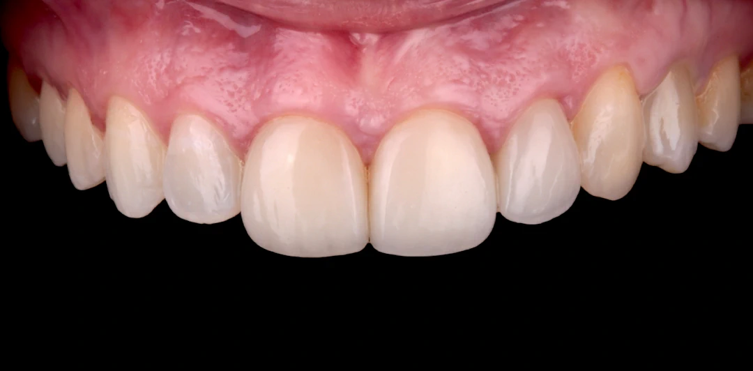 clinica-dental-gilbel-arques-caso-carillas-jag-5