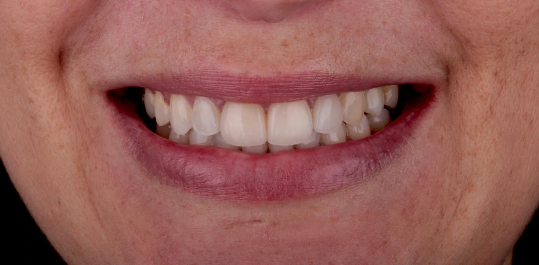 clinica-dental-gilbel-arques-caso-carillas-jag-6