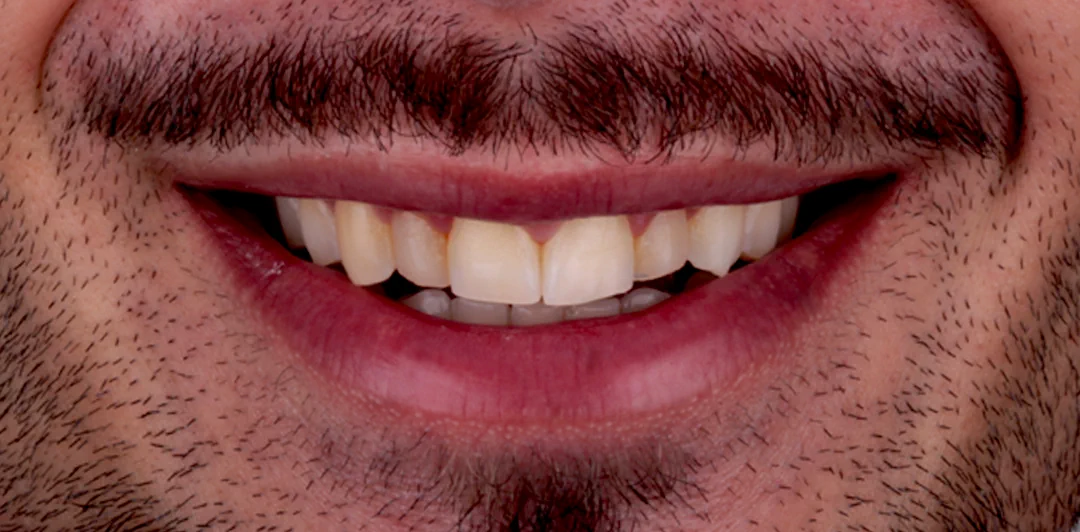 clinica-dental-gilbel-arques-caso-carillas-rgm-2