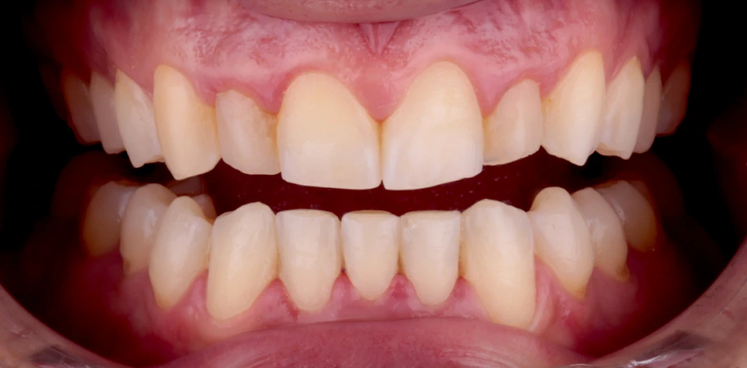 clinica-dental-gilbel-arques-caso-carillas-rgm-3