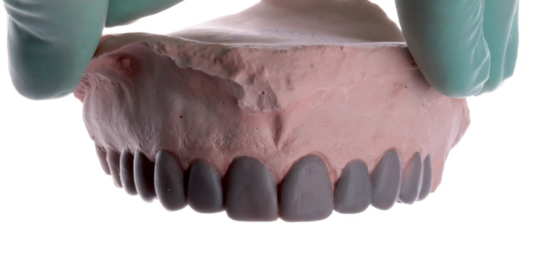 clinica-dental-gilbel-arques-caso-carillas-rgm-4