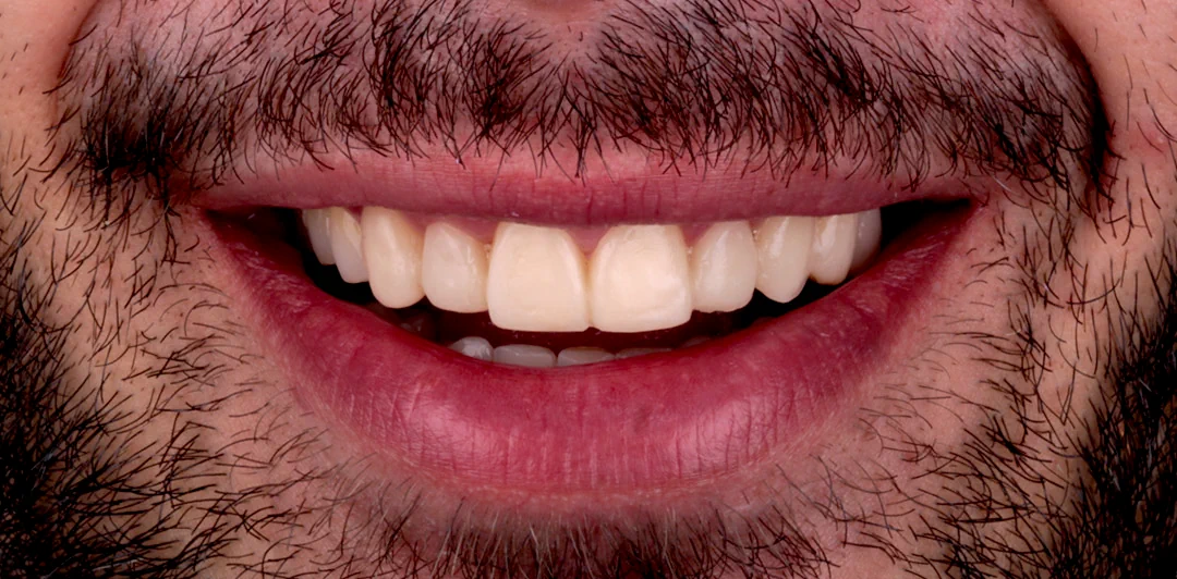clinica-dental-gilbel-arques-caso-carillas-rgm-5