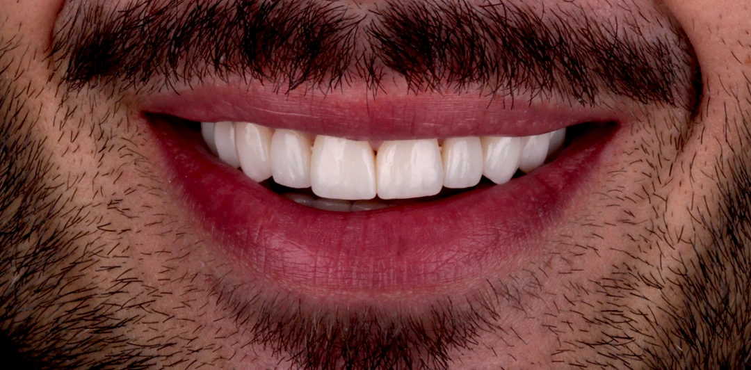 clinica-dental-gilbel-arques-caso-carillas-rgm-6
