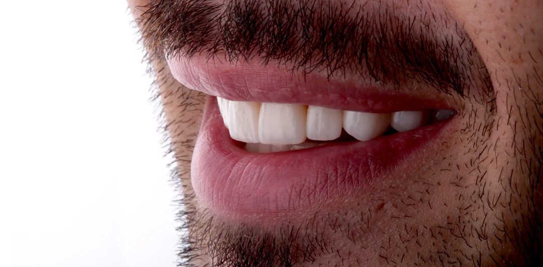 clinica-dental-gilbel-arques-caso-carillas-rgm-7