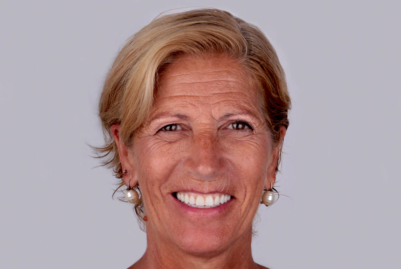 clinica-dental-gilbel-arques-caso-implante-dental-rgm-despues
