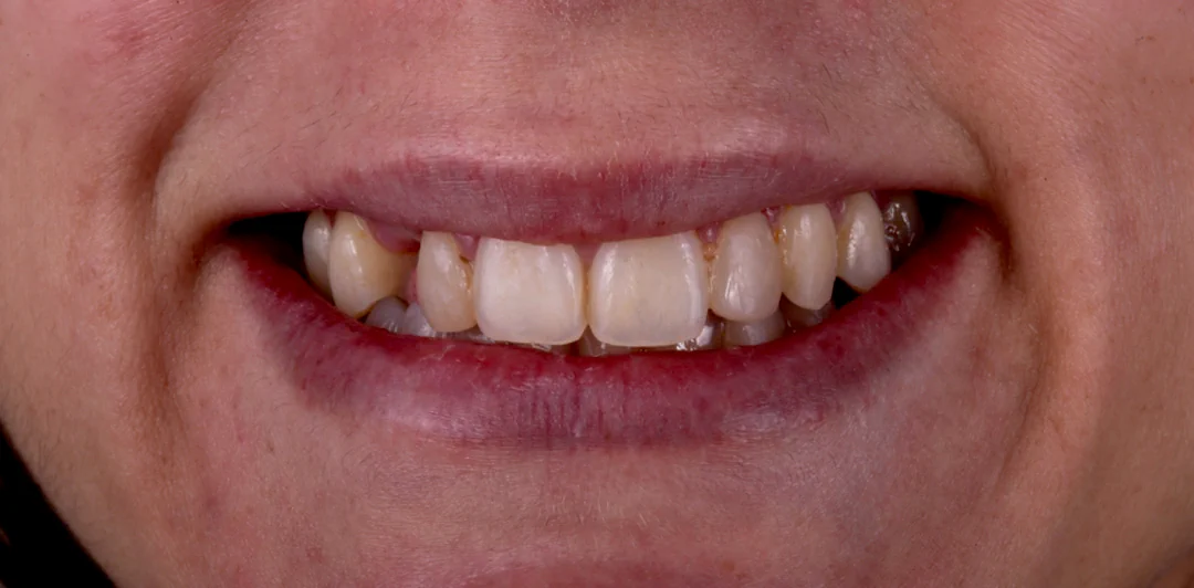 clinica-dental-gilbel-arques-caso-implante-dental-rpm-2
