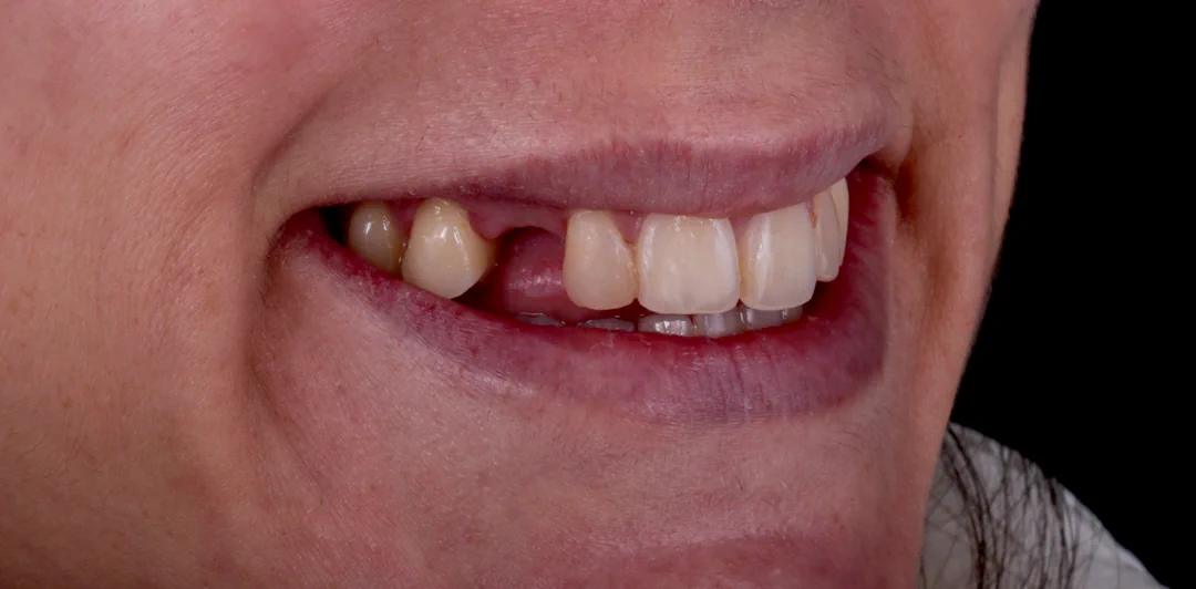 clinica-dental-gilbel-arques-caso-implante-dental-rpm-3