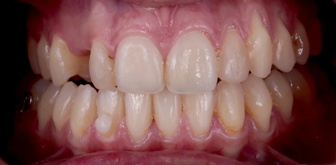 clinica-dental-gilbel-arques-caso-implante-dental-rpm-4