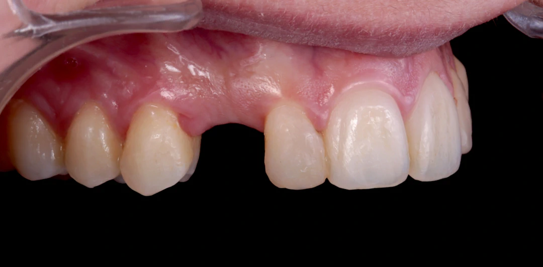 clinica-dental-gilbel-arques-caso-implante-dental-rpm-5