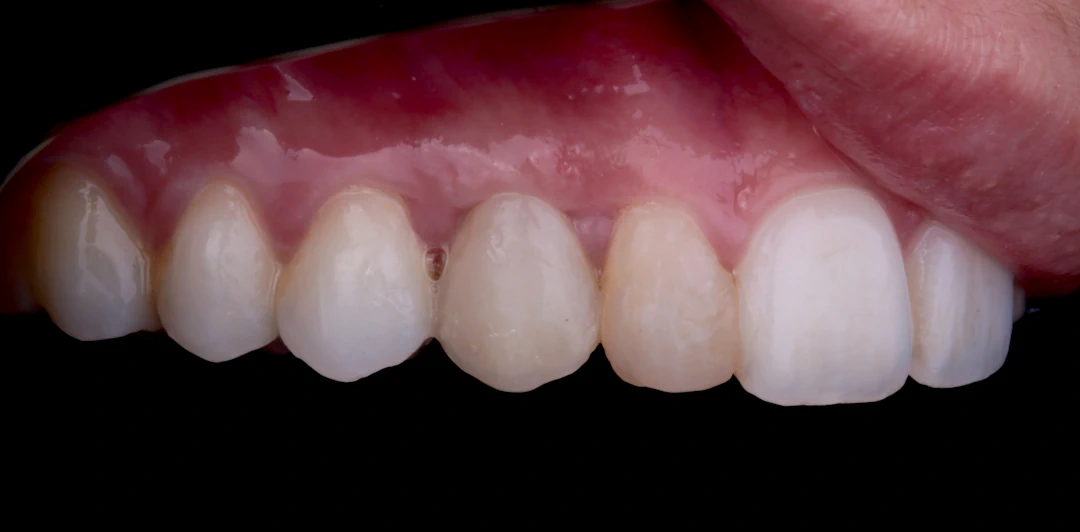clinica-dental-gilbel-arques-caso-implante-dental-rpm-6