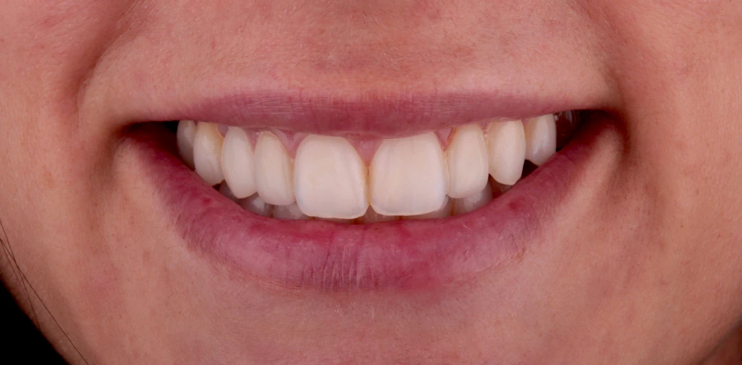 clinica-dental-gilbel-arques-caso-implante-dental-rpm-7