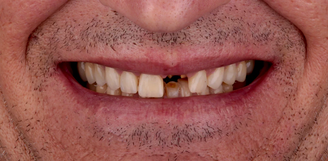 clinica-dental-gilbel-arques-caso-implente-dental-asm-1a