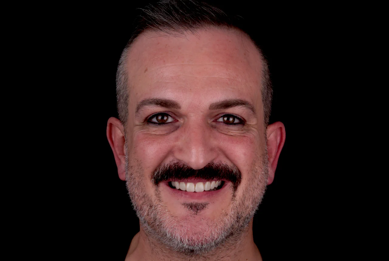 clinica-dental-gilbel-arques-caso-implente-dental-mgm-despues