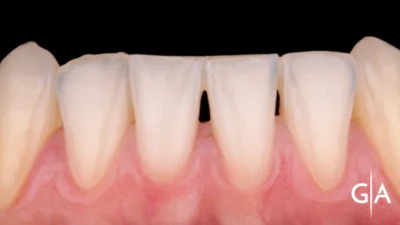 Estética Dental