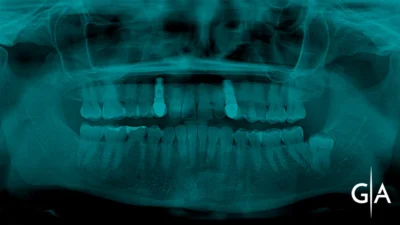 Cirugía Bucal – Dientes Retenidos