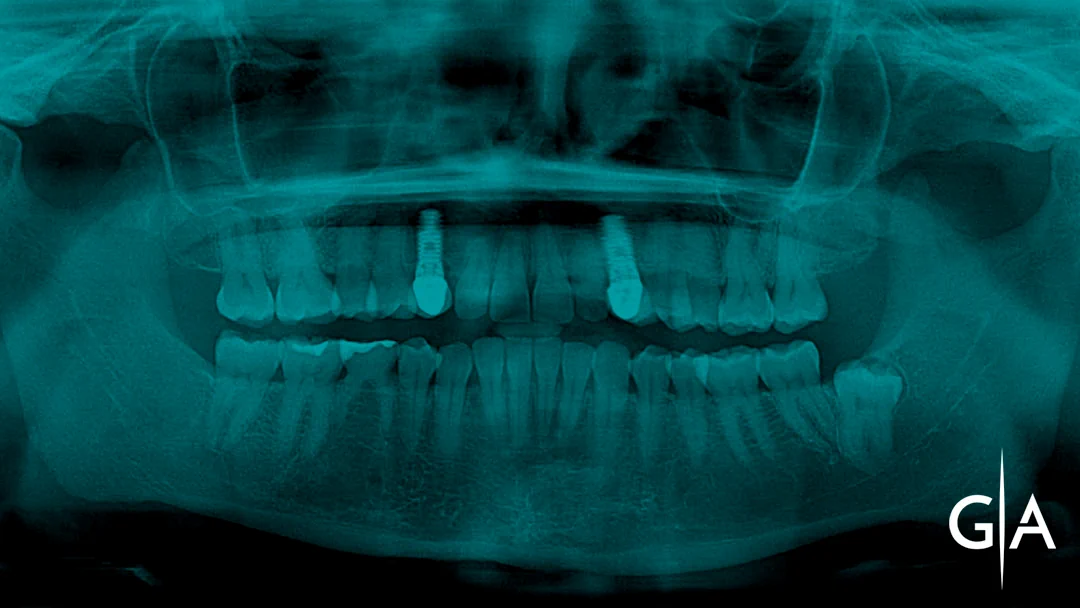 clinica-dental-gilbel-arques-cirugia-bucal-dientes-retenidos-0a