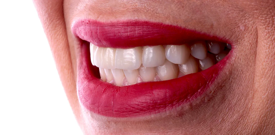 clinica-dental-gilbel-arques-caso-implante-carga-inmediata-raquel-10a