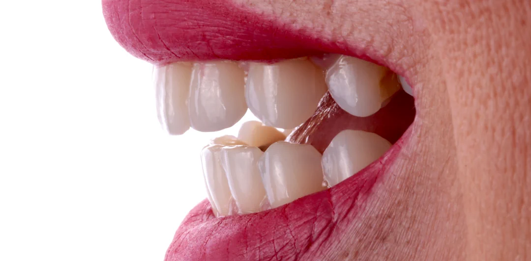 clinica-dental-gilbel-arques-caso-implante-carga-inmediata-raquel-11a
