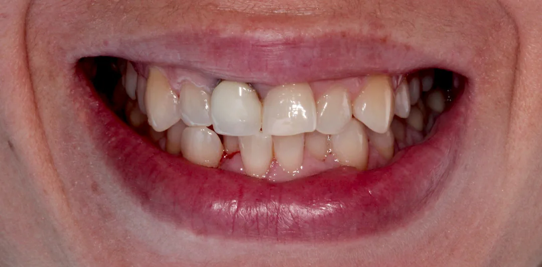 clinica-dental-gilbel-arques-caso-implante-carga-inmediata-raquel-1a