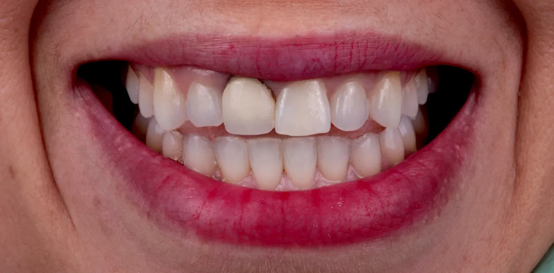 clinica-dental-gilbel-arques-caso-implante-carga-inmediata-raquel-2a