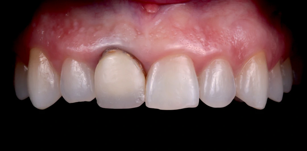 clinica-dental-gilbel-arques-caso-implante-carga-inmediata-raquel-3a