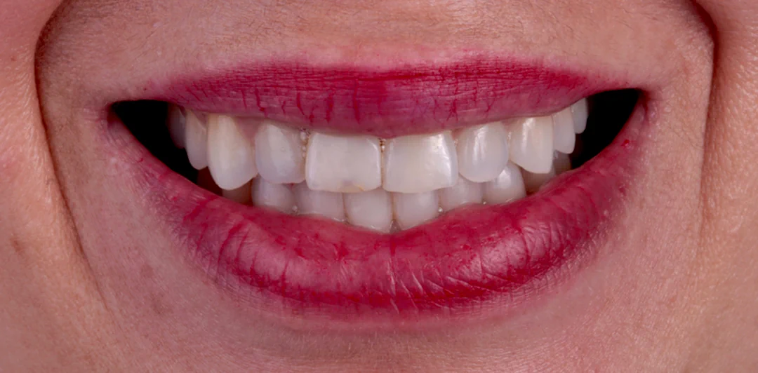 clinica-dental-gilbel-arques-caso-implante-carga-inmediata-raquel-6b