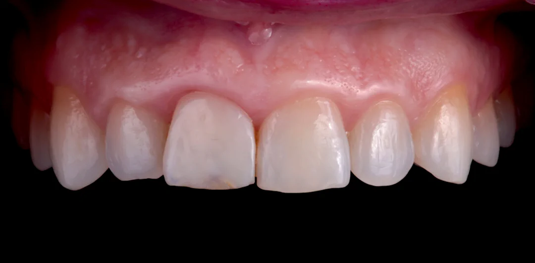 clinica-dental-gilbel-arques-caso-implante-carga-inmediata-raquel-7b