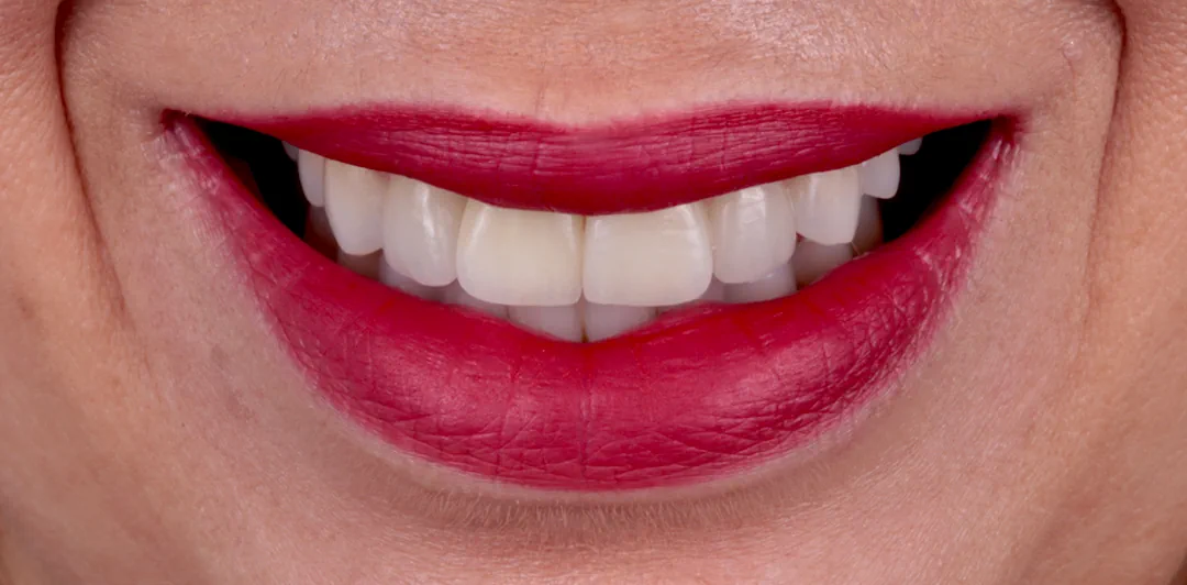 clinica-dental-gilbel-arques-caso-implante-carga-inmediata-raquel-8a