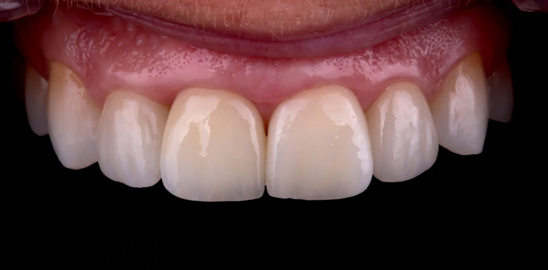 clinica-dental-gilbel-arques-caso-implante-carga-inmediata-raquel-9a