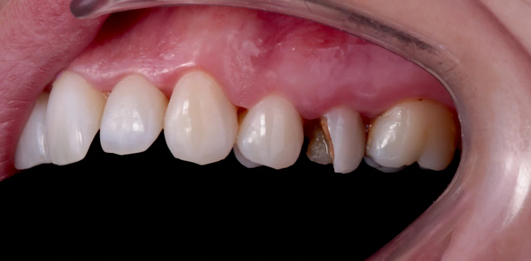 clinica-dental-gilbel-arques-caso-implante-carga-inmediata-rebeca-1a