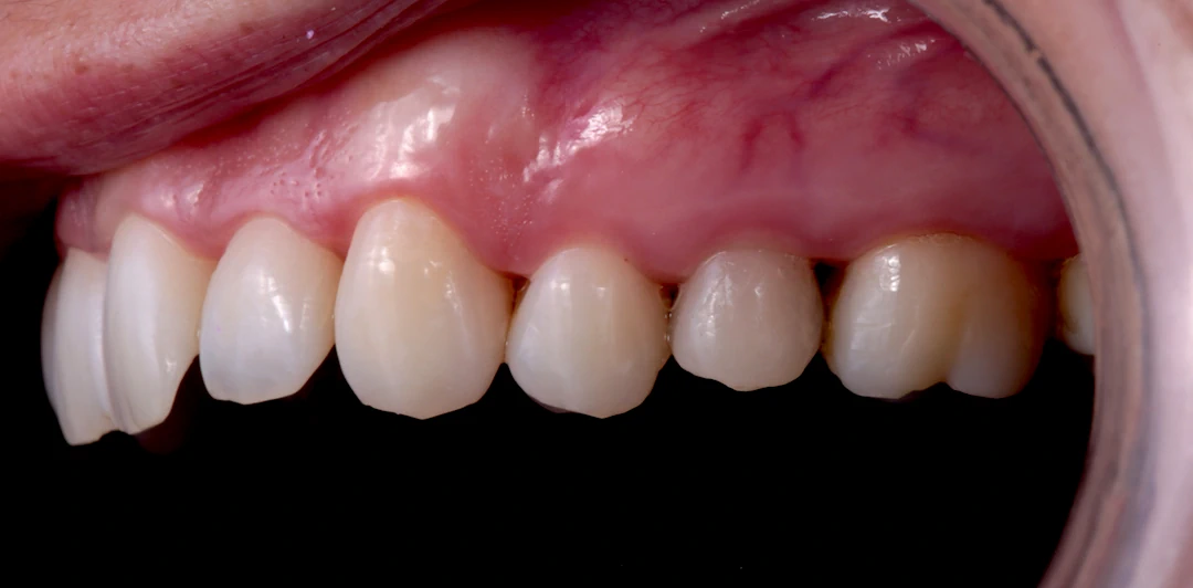 clinica-dental-gilbel-arques-caso-implante-carga-inmediata-rebeca-2a