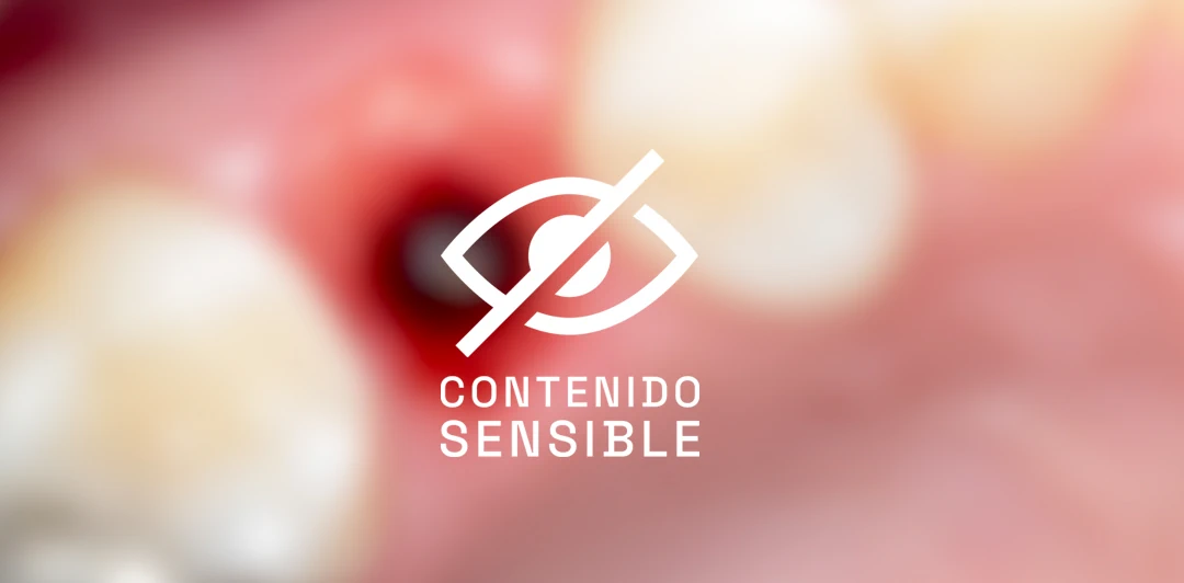 clinica-dental-gilbel-arques-caso-implante-carga-inmediata-rebeca-3b