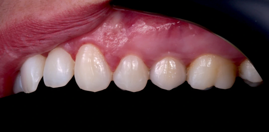 clinica-dental-gilbel-arques-caso-implante-carga-inmediata-rebeca-4b