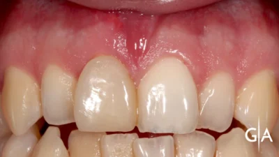 Cirugía Bucal – Implantes Inmediatos con Carga Inmediata. ICRO.