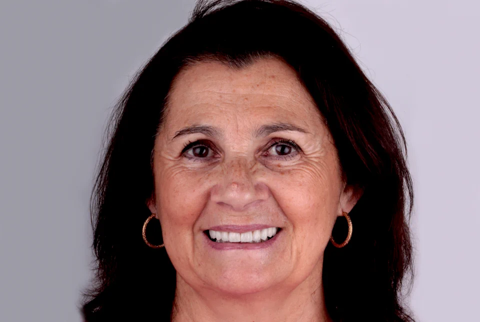 clinica-dental-gilbel-arques-caso-carillas-aoc-despues