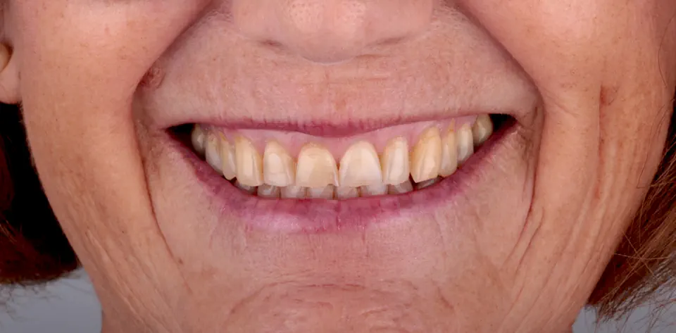 clinica-dental-gilbel-arques-caso-estetica-dental-cql-1