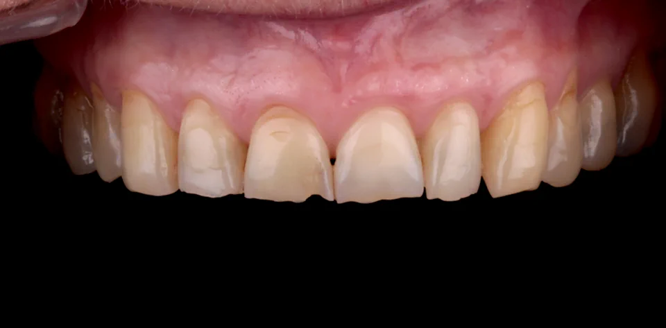 clinica-dental-gilbel-arques-caso-estetica-dental-cql-2
