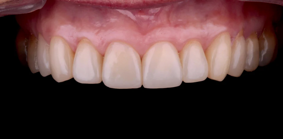 clinica-dental-gilbel-arques-caso-estetica-dental-cql-3