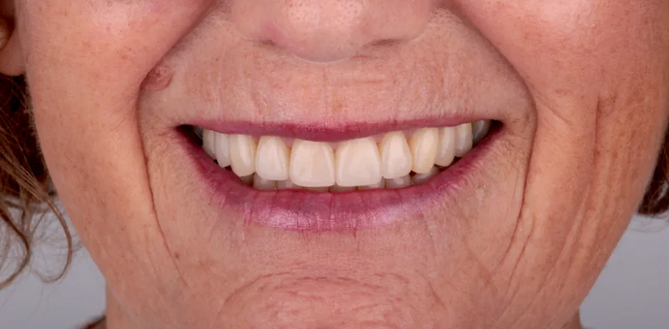 clinica-dental-gilbel-arques-caso-implante-dental-cql-4