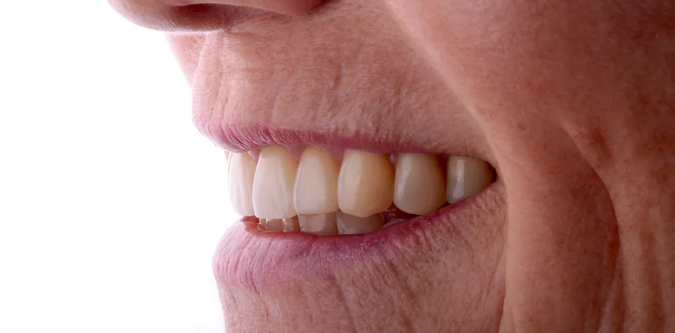 clinica-dental-gilbel-arques-caso-implante-dental-cql-5
