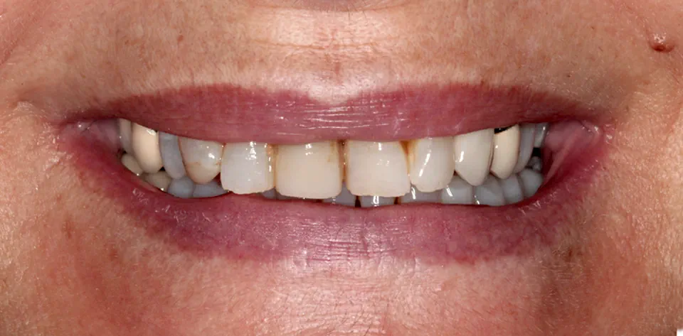 clinica-dental-gilbel-arques-caso-implante-dental-pc-1