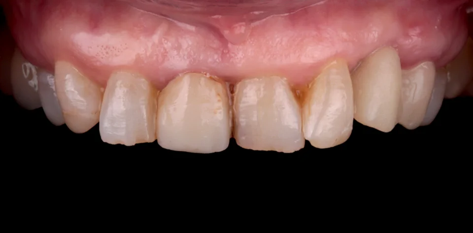 clinica-dental-gilbel-arques-caso-implante-dental-pc-2b
