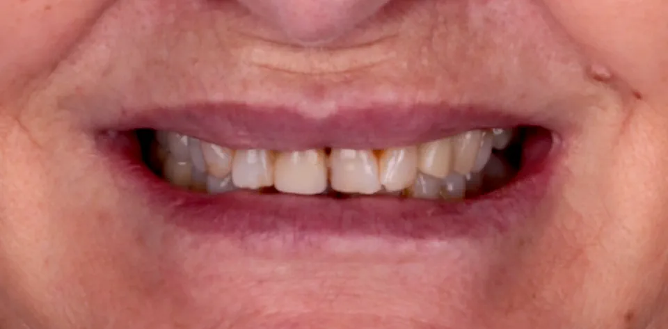 clinica-dental-gilbel-arques-caso-implante-dental-pc-4